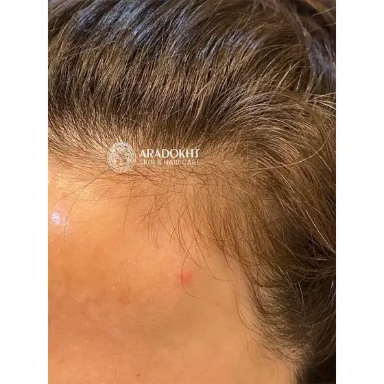 سرم ضد جوش سوکسینیک اسید مدی کیوب 40 گرم
